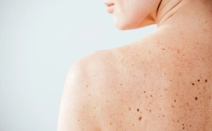 3-melanoma-pelle-neo-marina-conese-dermatologa