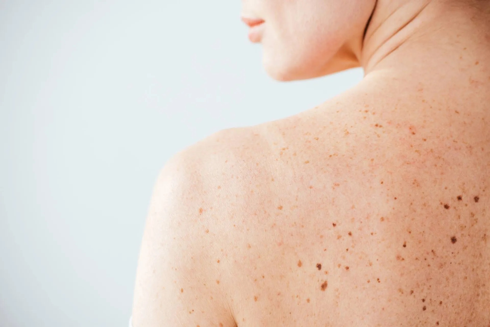 3-melanoma-pelle-neo-marina-conese-dermatologa