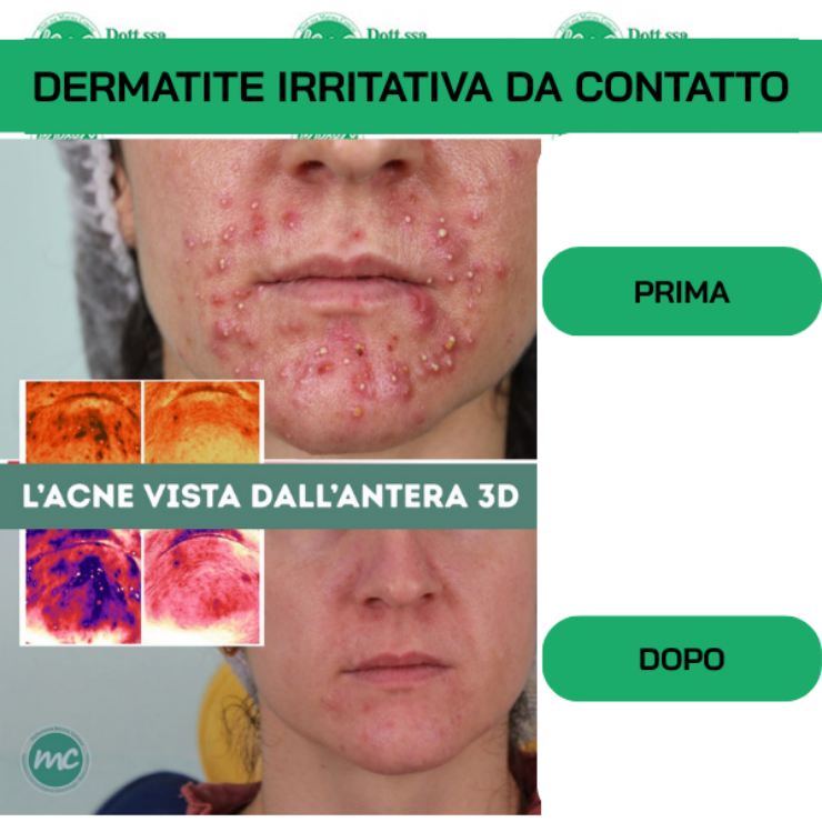Dermatite irritativa da contatto