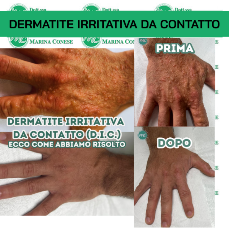 Epilazione Laser Alessandrite RISOLTA
