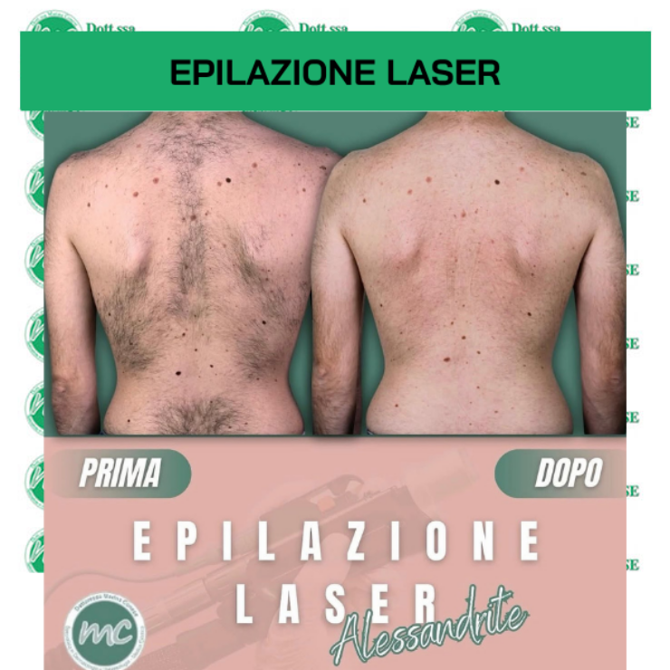 Epilazione Laser Alessandrite