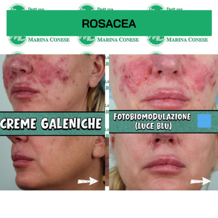 rosacea trattamento fotobiomodulazione creme galeniche